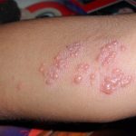 Vacinação contra herpes-zóster é fundamental para prevenir a doença na terceira idade